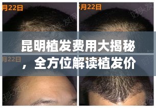 昆明植发费用大揭秘，全方位解读植发价格，让您明明白白消费！